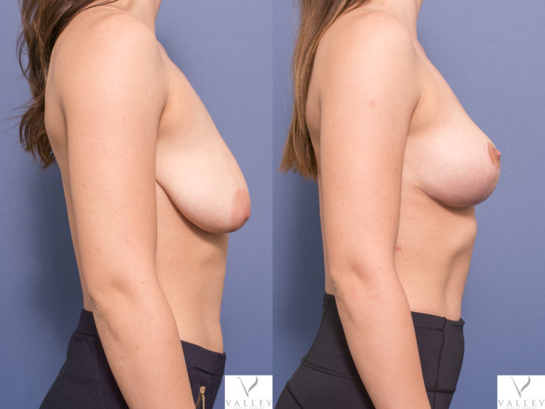 Dr Peters breast lift patient before and after surgery 1C