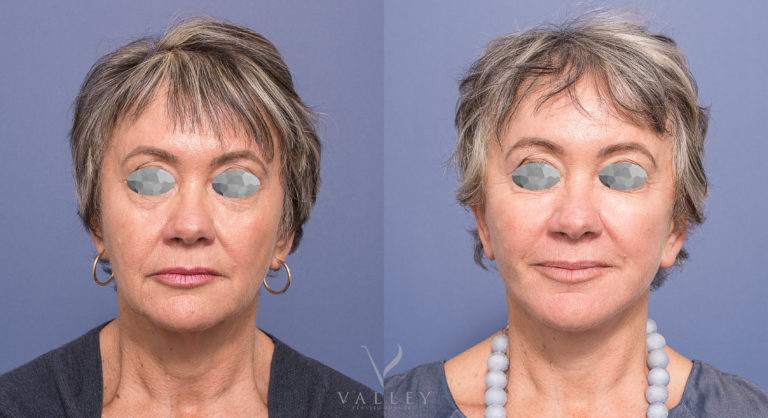 Facelift surgery before and after 01, Dr Peters Brisbane QLD