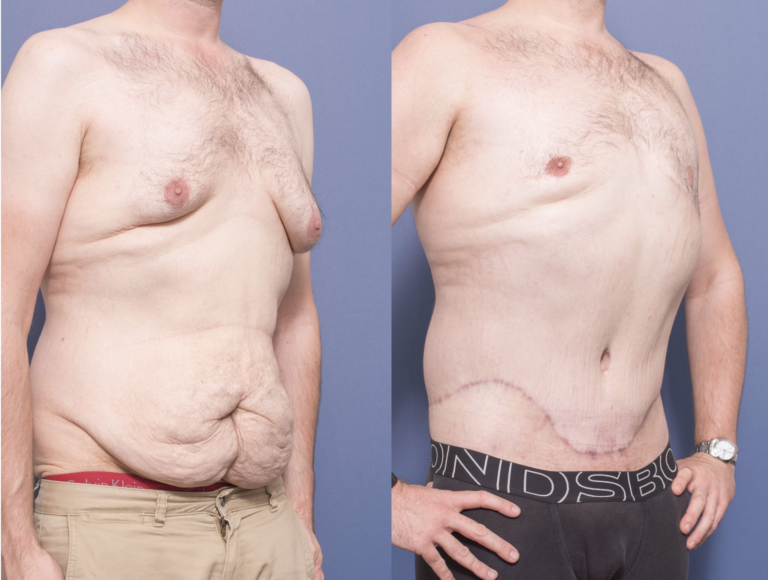 Male Body Lift - Belt Lipectomy and Gynecomastia, before & after 4B