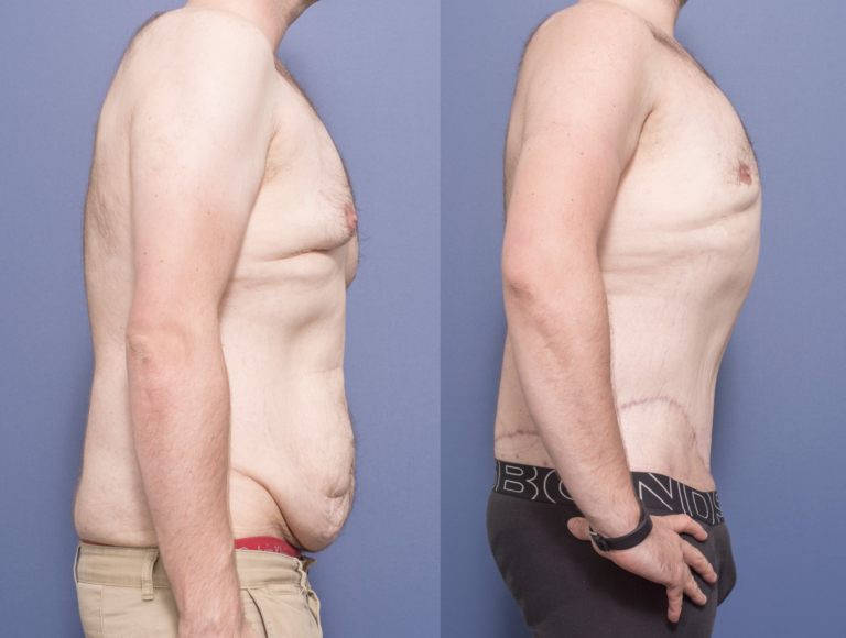 Male patient before and after body lift (male breast reduction & belt lipectomy), before & after 4C